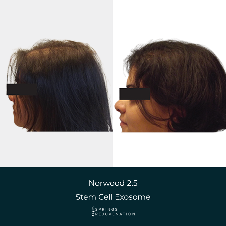 Norwood 2.5 Stem Cell Exosome